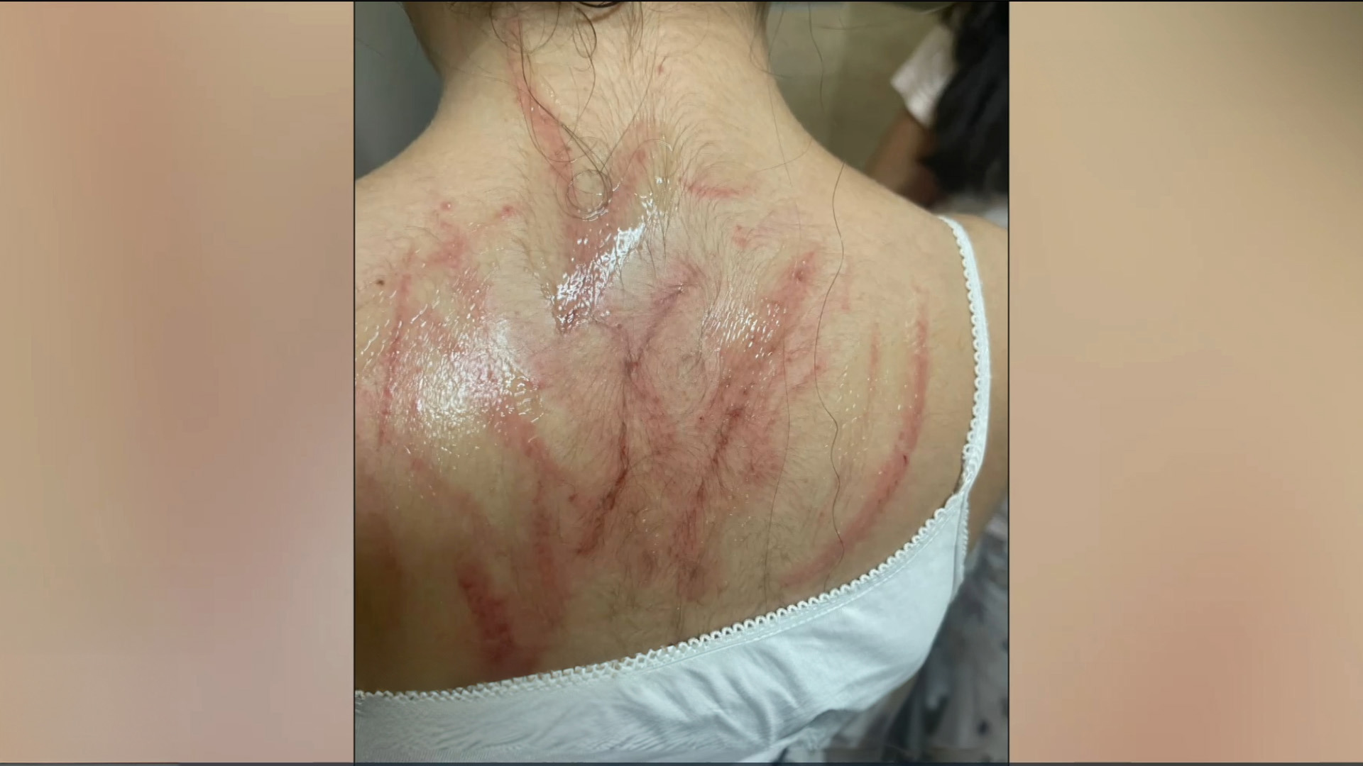 אמה של הילדה שתקפה את בת כיתתה מגיבה: "לא מצדיקה, הבת שלי בטראומה"